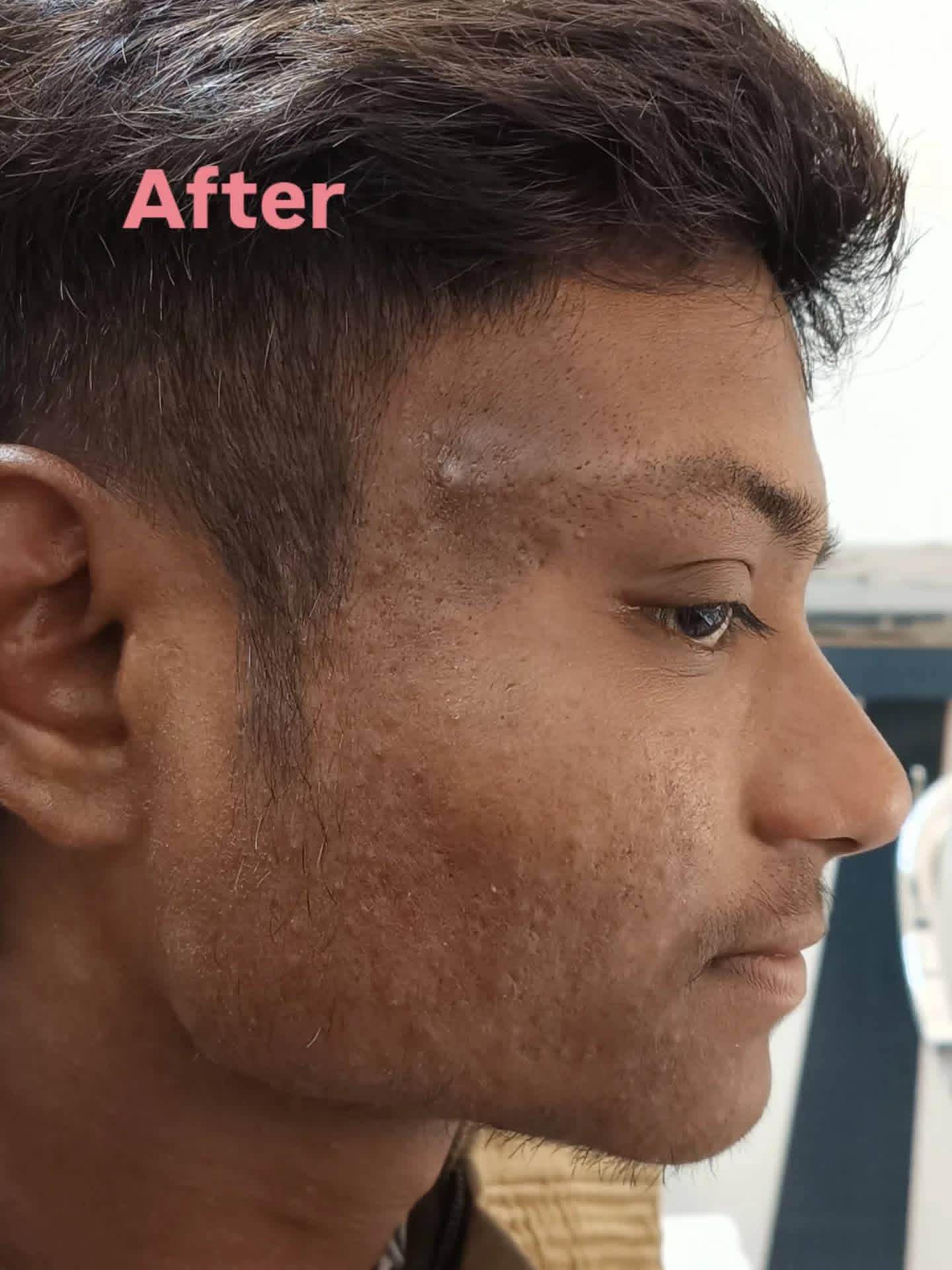After treatment