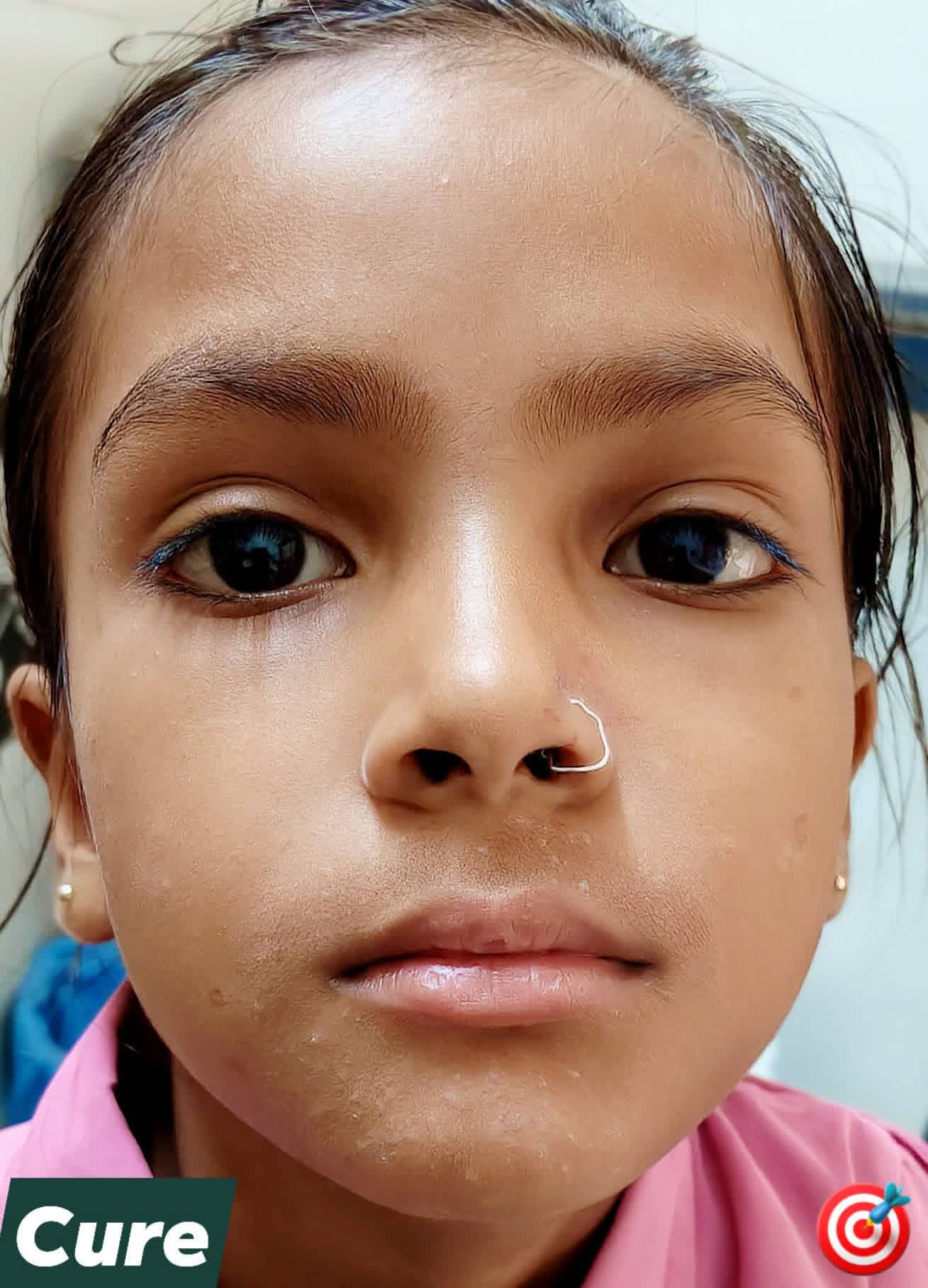 After treatment