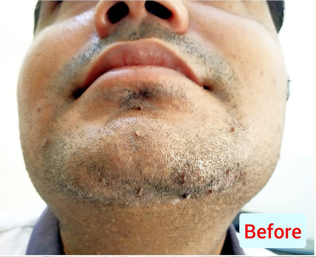 Before treatment